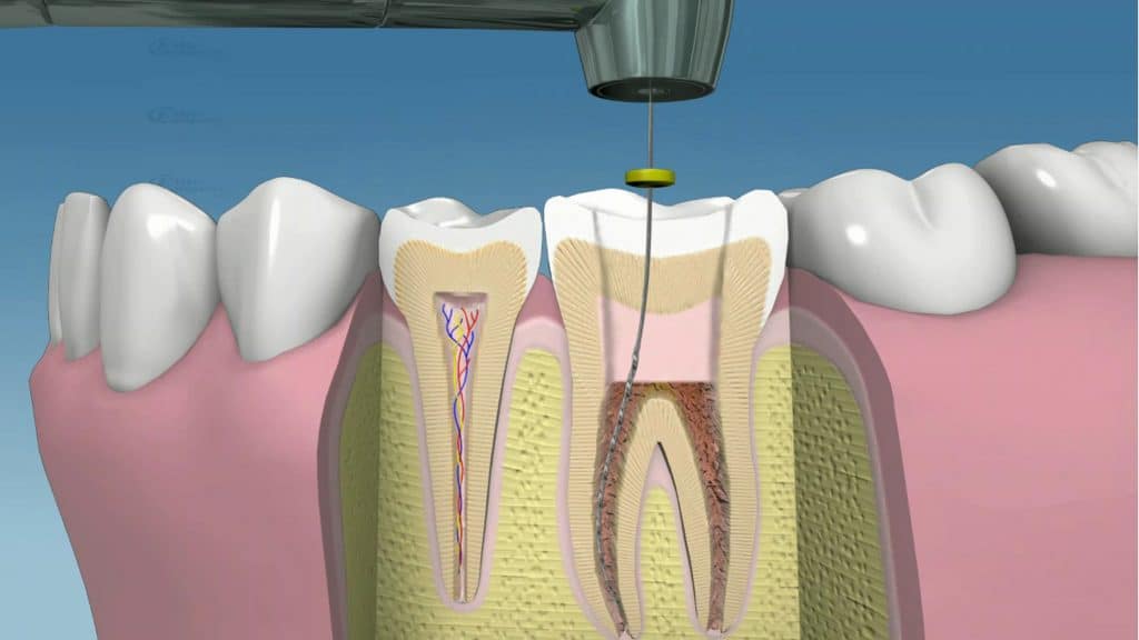 endodoncia