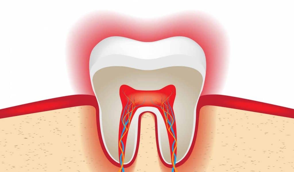 endodoncia