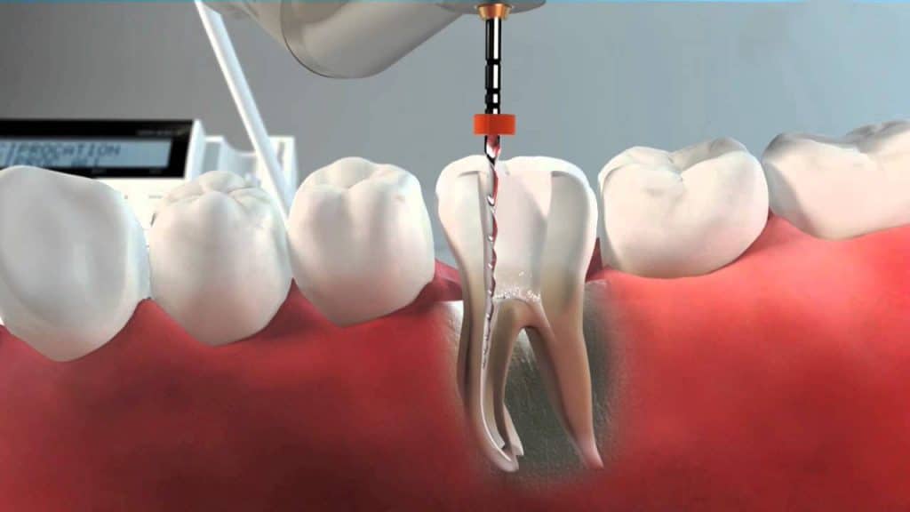 endodoncia