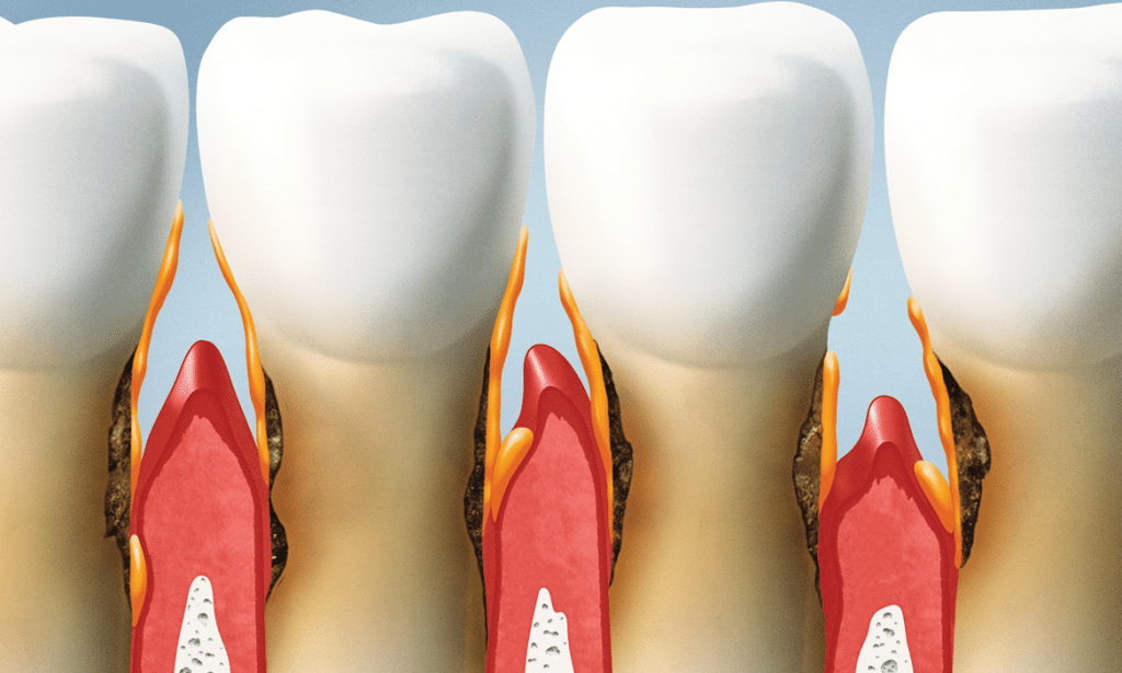 periodoncista